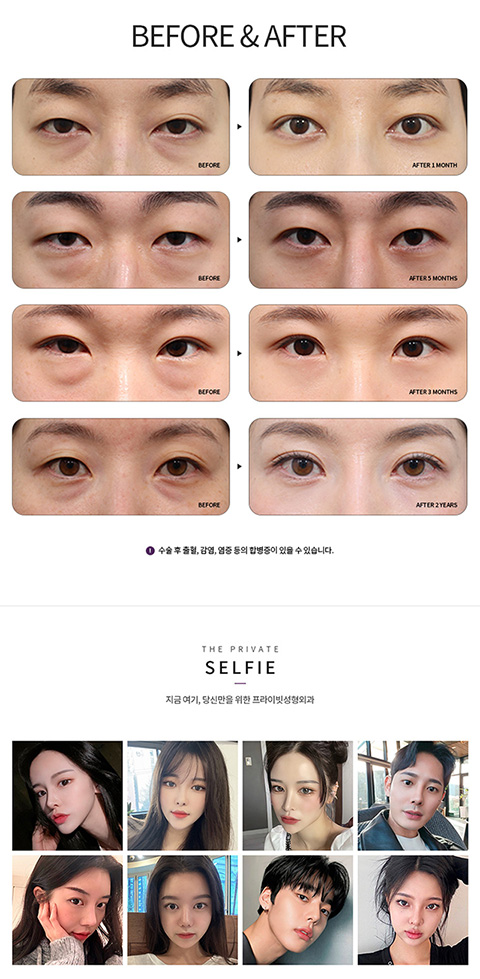 눈밑지방재배치